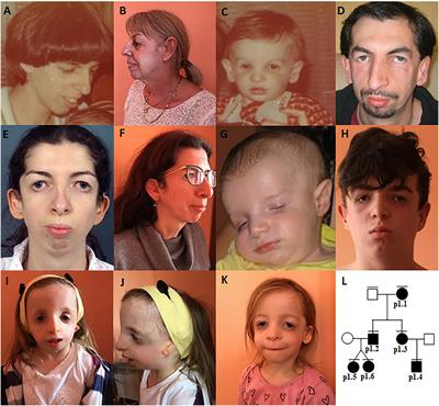 Targeted Next-Generation Sequencing in the Diagnosis of Facial Dysostoses